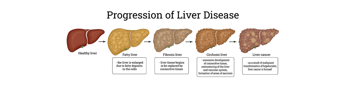 Fatty Liver | Center for Advanced Research & Education